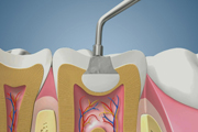 Amalgam Filling Large (Cross Section)